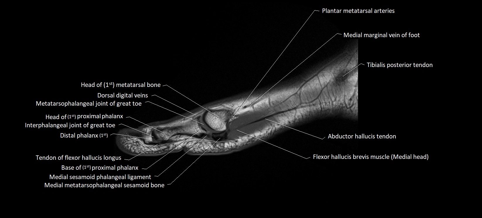 MRI foot sagittal labelled cross sectional anatomy image  3.webp